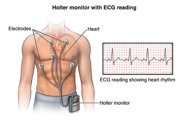 A Holter készülék mobilis, folyamatos EKG monitorozást tesz lehetővé, de ránézésre is érezzük, hogy nem egy kényelmes darab.