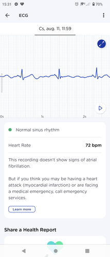 EKG, véroxigénszint és pulzus a ScanWatch Horizon által mérve.